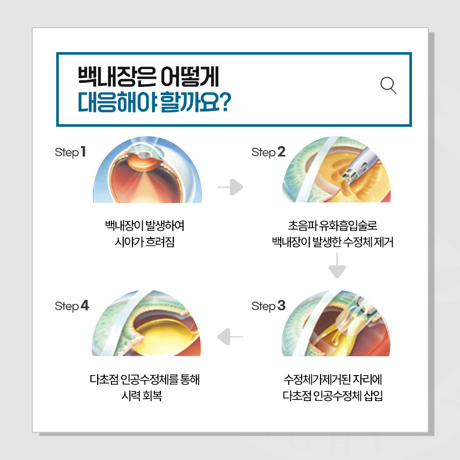 백내장은 어떻게 대응해야할까요?